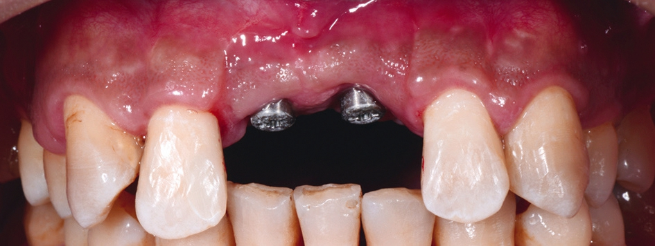 Abb. 1: Die Situation nach der Einheilung der Implantate regio 11 und 21.