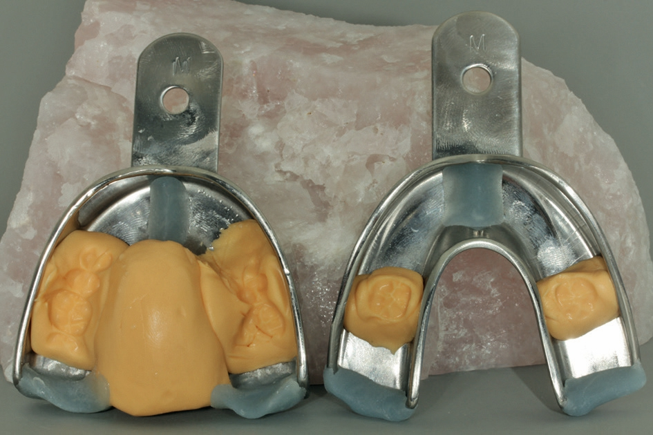 Abb. 1: Löffel fertig individualisiert. Inzisalstopp und dorsale Abdämmung aus Lichtkunststoff, Palatinalstopp und Darstellung des 6er/7er-Bereichs aus Silikon.