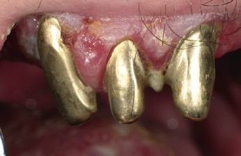 Abb. 1: Xerostomie und Entzündung der Mundschleimhaut.