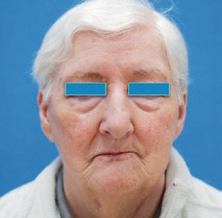 Abb. 1: 79-jährige Patientin.