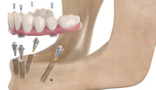 Beim SmartFix-Konzept wird eine verschraubte Brücke oder Stegprothese im Ober- oder Unterkiefer von lediglich vier Implantaten gestützt.