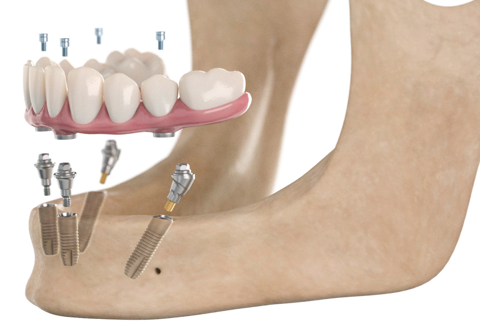 Beim SmartFix-Konzept wird eine verschraubte Brücke oder Stegprothese im Ober- oder Unterkiefer von lediglich vier Implantaten gestützt.