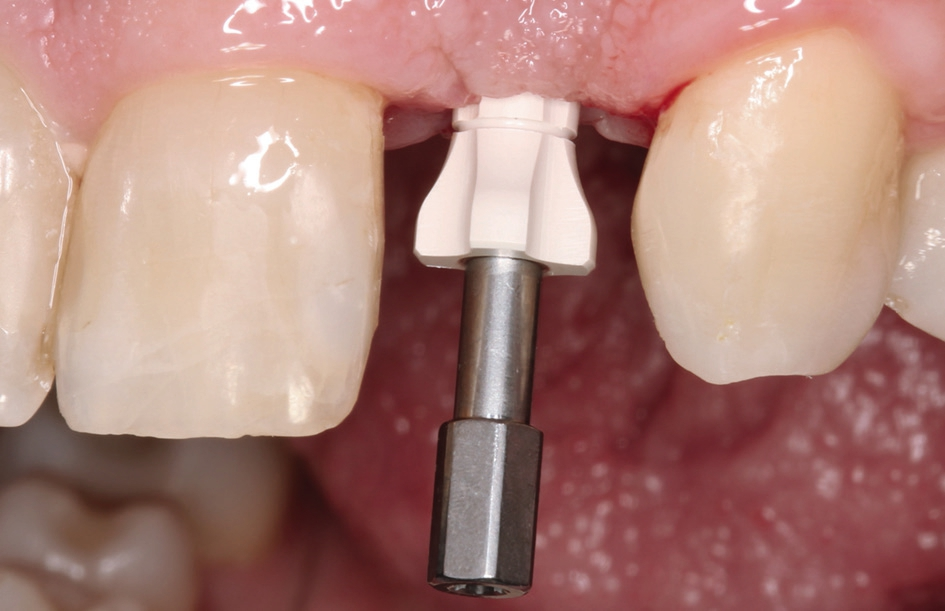Abb. 16: Zwei Wochen nach der Freilegungs-OP mit Rolllappen wurde der Gingivaformer entfernt …