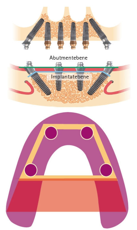 Abb. 1 bis 3: Großflächiges Unterstützungspolygon im Ober- und Unterkiefer durch nach posterior verlagerte Durchtrittsprofile.
