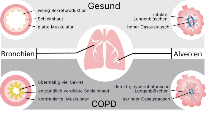 Abb. 1: Veränderungen in der Lungenstruktur bei COPD: chronische Bronchitis (links) und Emphysem (rechts).