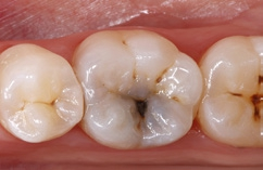 Abb. 1: Ausgangssituation: primärkariöse Läsion in Zahn 36 (Foto über Intraoralspiegel).