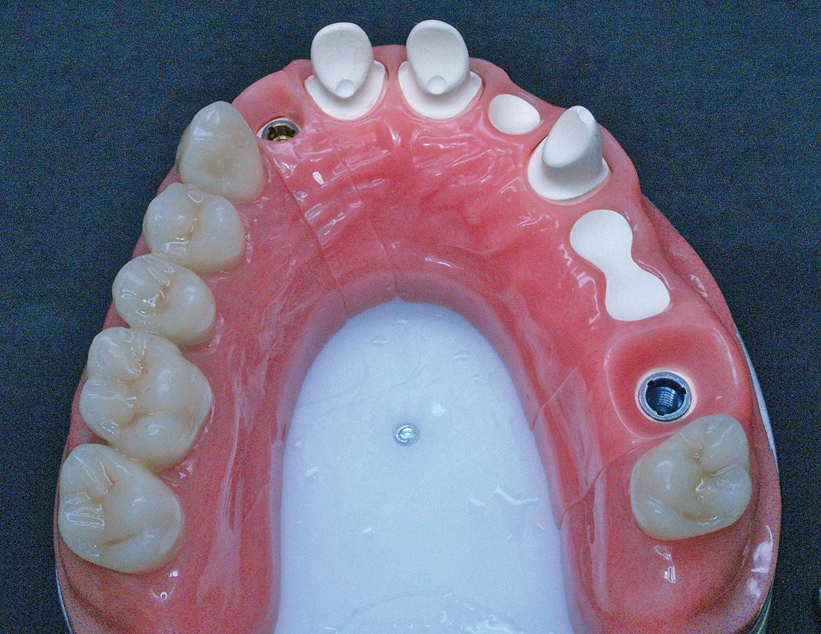 Abb. 1: Prothetische Ausgangssituation.