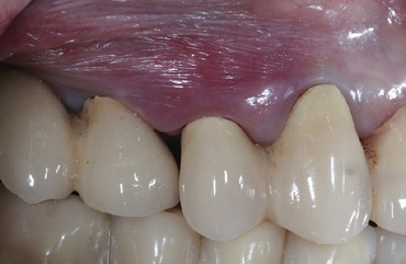 Abb. 1: Im Ausgangsbefund zeigt die Mukosa regio 14, 15 eine Rötung und eine Anschwellung im Interdentalraum 13/14. Distal des Zahnes 14 ist ein deutlicher Verlust der Papille sichtbar.