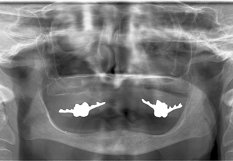 Abb. 1: Ausgangssituation auf Röntgenbild. Die Vollprothese im Unterkiefer soll mit vier Mini-Implantaten stabilisiert werden.