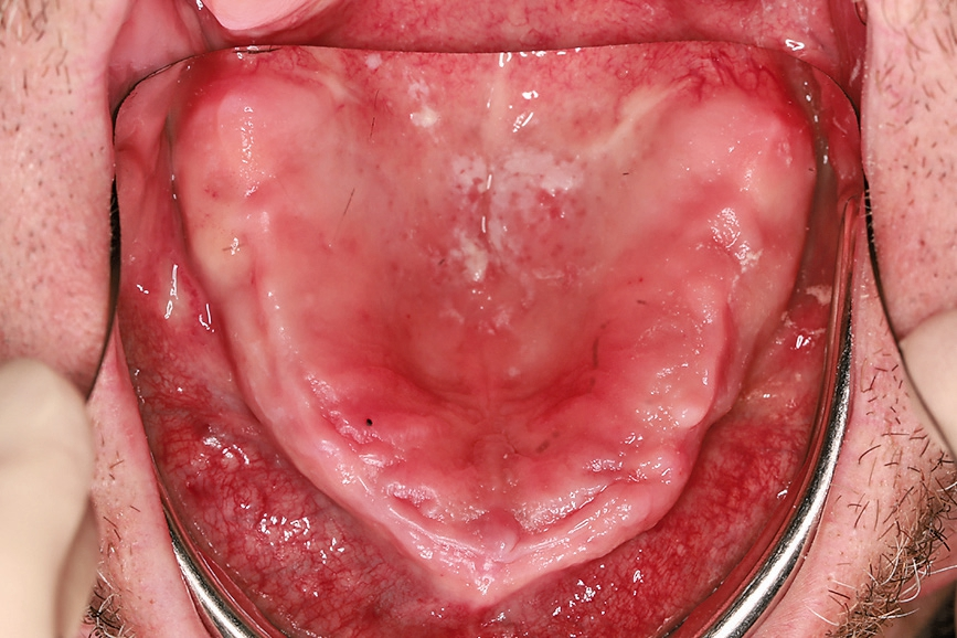 Abb. 1: Ausgangsbild Schleimhautsituation im Oberkiefer.