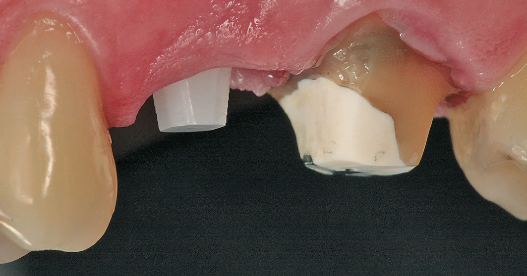 Abb. 1a: Die prothetische Ausgangssituation von oral.