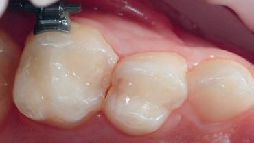Abb. 1: Ausgangssituation: Zahn 54 distal mit einer Karies.