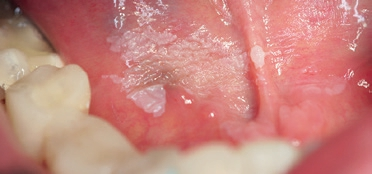 Abb. 1: Leukoplakia simplex des Mundbodens.