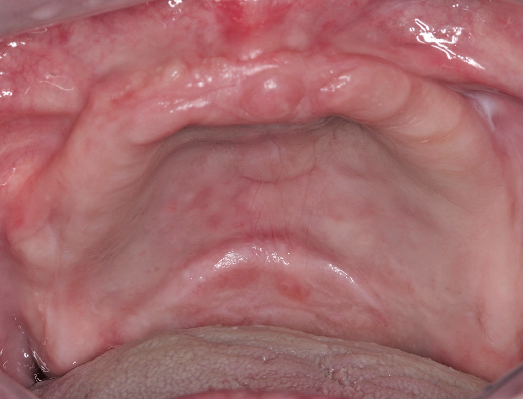 Abb. 1: Ausgangssituation intraoral, zahnloser Oberkiefer.