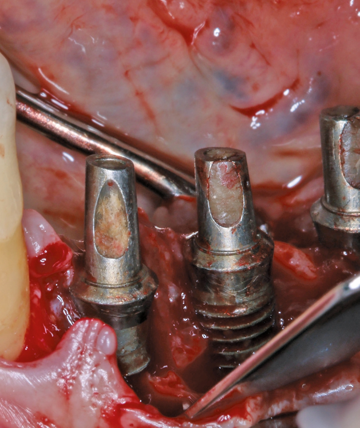 Klinisches Bild einer Periimplantitis.