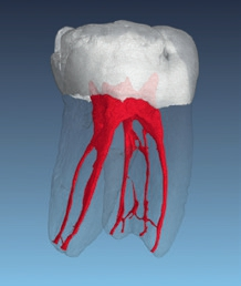 Abb. 1: Micro-CT von Zahn 46.