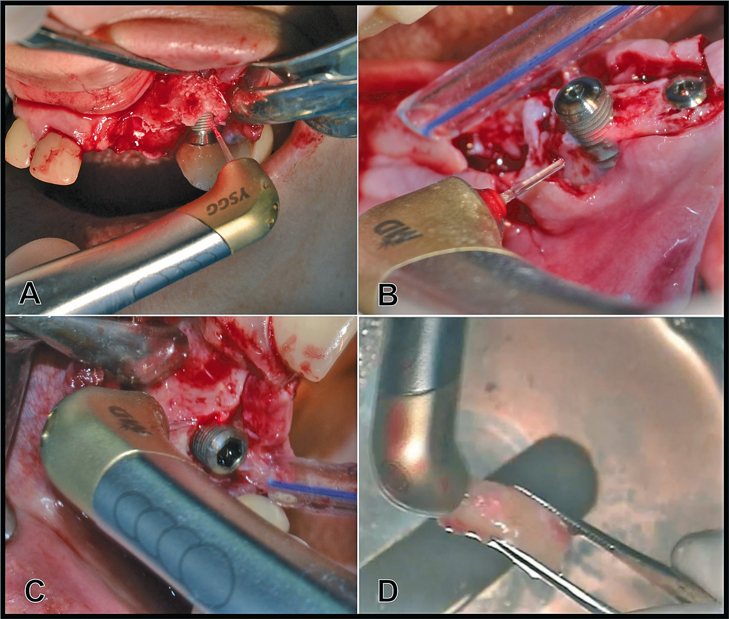 Abb. 9: Darstellung von Anwendungen des Er,Cr:YSGG-Lasers. A) bis C) Weich- und Hartgewebsresektive Periimplantitis-Operation mit Entfernung nekrotischer Knochenanteile. Die Implantatoberfläche wird mit einem defokussierten Brennpunkt des Laserstrahls dekontaminiert. Wichtig zu wissen ist, dass der rote Lichtpunkt NICHT der eigentlich aktive (unsichtbare) Laserstrahl ist, sondern lediglich ein „Laserpointer“ zur Positionsbestimmung. D) Verwendung des Lasers für extrakorporale Bearbeitung (Formung) von autologen Knochentransplantaten.