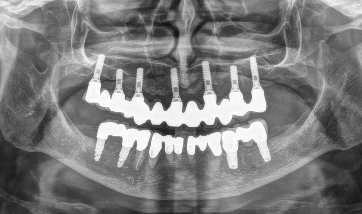 Abb. 1: OPG zwei Jahre vor erneuter Implantation.