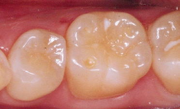Abb. 1: Typische erosive Läsion der Okklusalfläche 36 bei einer 24-jährigen Patientin. Der Boden der Kavitäten auf den Höckerspitzen zeigt exponiertes Dentin.