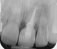 Abb. 1: Einzelzahnaufnahme Zahn 21 nach wiederkehrender marginaler Gingivitis. Erstdiagnose ext. Resorption, daher als nicht erhaltungswürdig eingestuft.
