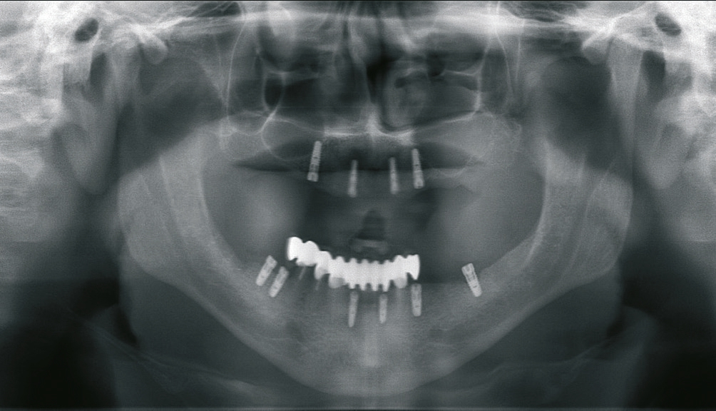 Abb. 1: Die alte Versorgung und neue Implantate.