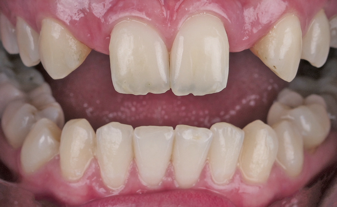 Abb. 1: Ausgangssituation im Mund.