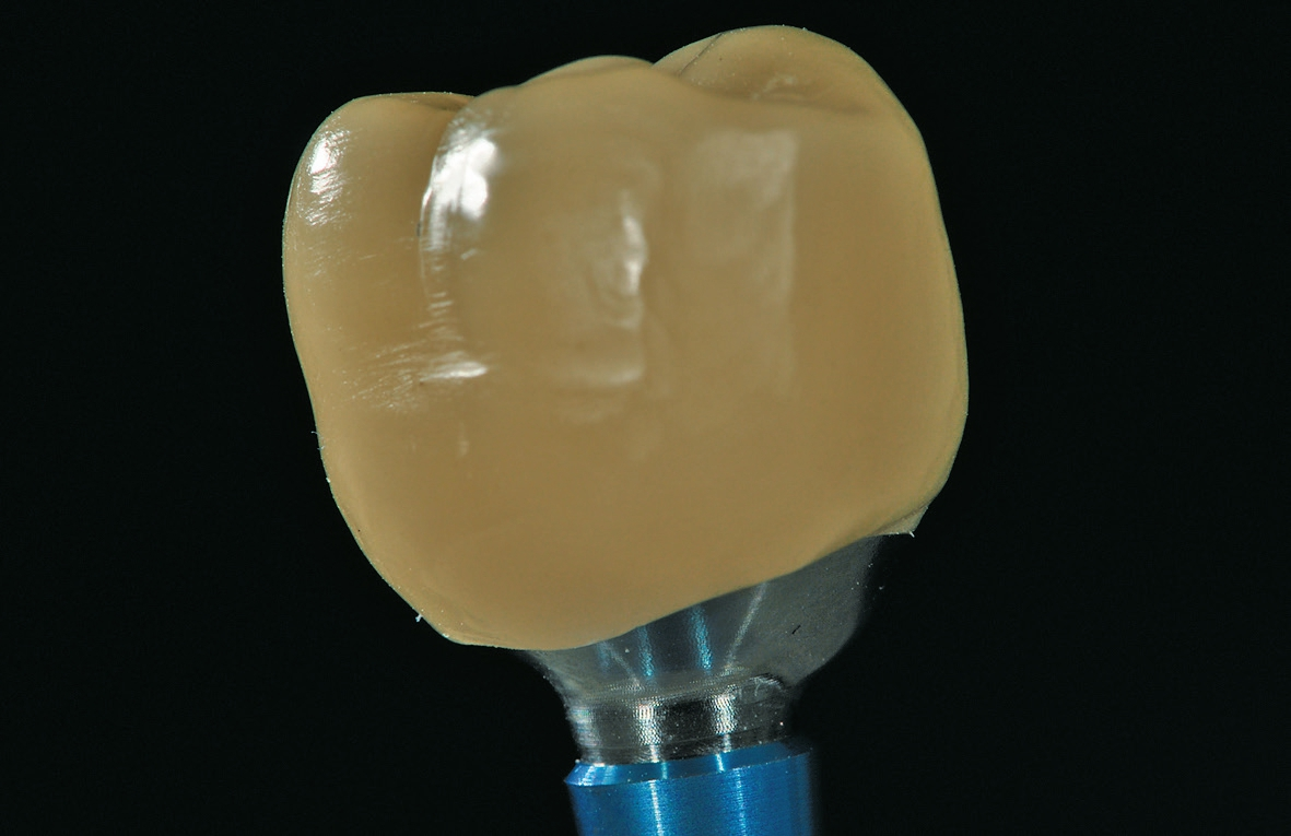 Abb. 23: Eine monolithische Krone aus Enamic LT (VITA Zahnfabrik, Bad Säckingen) auf einem individuell gefrästen Abutment (Astra Tech Implantatsystem EV/Dentsply Sirona; Sirona Dental Systems, Bensheim) für einen oberen 6-er. In diesem Bereich steht für uns die Funktionalität vor der Ästhetik. In dem Material Enamic wird versucht, die elastischen und schockabsorbierenden Eigenschaften der Natur nachzuahmen, indem Keramik und Polymer in einem speziellen Verfahren verbunden werden.