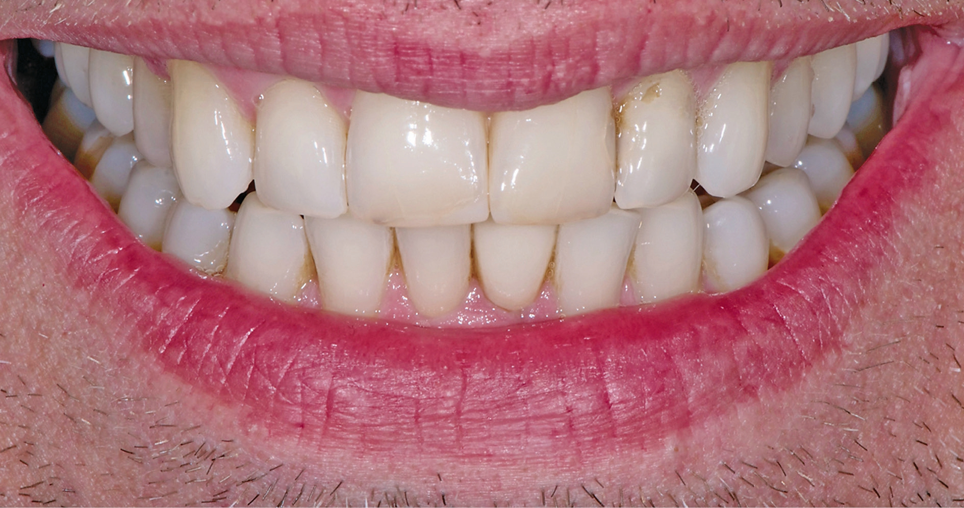 Abb. 1: Ausgangssituation. Die Zähne 11 und 21 sollen mit Veneers versorgt werden.