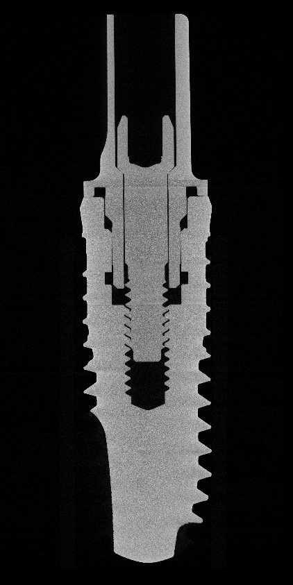 Abb. 12: CT-Analyse-Schichtbild zur exemplarischen Passgenauigkeit bzw. Kompatibilität von Viteo Base und Viteo Screw zum Implantat.