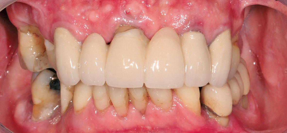 Abb. 1: Ausgangsbefund intraoral mit retrahierten Lippen.