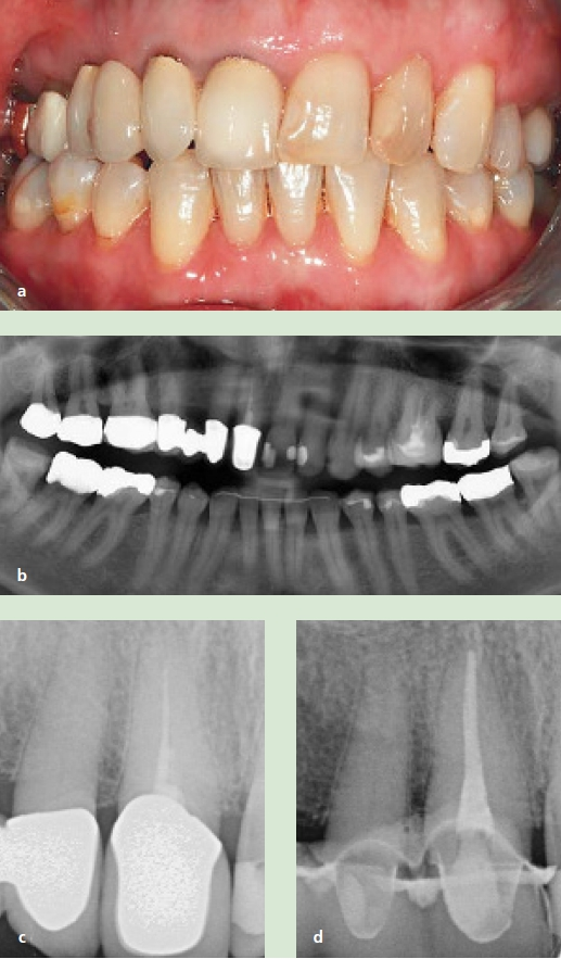 Abb. 1a-d: a) Klinische Ausgangssituation. b) OPG. c) Insuffiziente Wurzelfüllung 12 – Röntgenstatus Ausgangssituation. d) Wurzelfüllung 12 nach Revision.