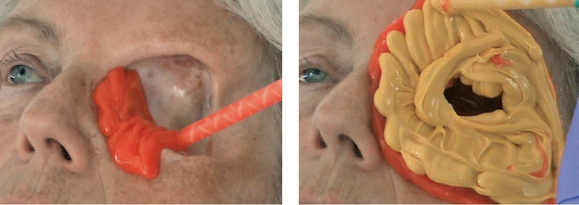 Abb. 1a u. b: Konventionelle Abformung einer Orbita mittels Polyvinylsiloxan für die Herstellung einer Augenepithese. Das Eigengewicht des aufgebrachten Silikons kann die unterliegenden Strukturen stauchen. Diese Abformungen sind für die Patienten sehr unangenehm und verursachen bei der Entformung durch die Unterschnitte oder auch Schleimhautkontakt erhebliche Schmerzen.