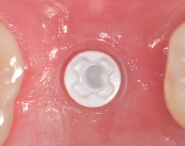 Abb. 1: Für Keramikimplantate spricht ein entzündungsfreies Weichgewebe.