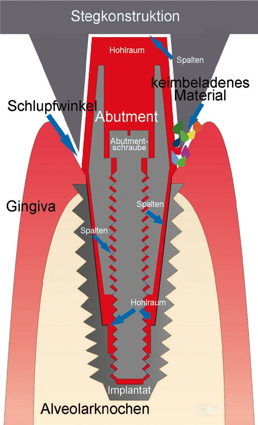 Abb. 1: Schematische Darstellung eines zusammengesetzten enossalen Implantates mit einer Stegkonstruktion. Die Schlupfwinkel, Hohl- und Spalträume im Implantat und der Suprastruktur sind durch Pfeile markiert.