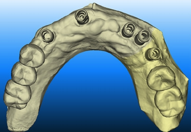 Abb. 1: Implantatabformung.