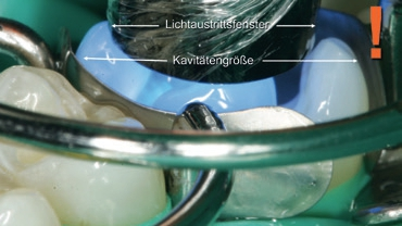 Abb. 1: Verdeutlichung der Diskrepanz zwischen Lichtaustrittsfenster und Kavitätendurchmesser: Bei derart unterschiedlichen Durchmessern ist unbedingt mehrfach/überlappend zu polymerisieren – und das auch bereits beim Adhäsiv!