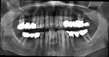 Abb. 1: OPG Ausgangssituation.