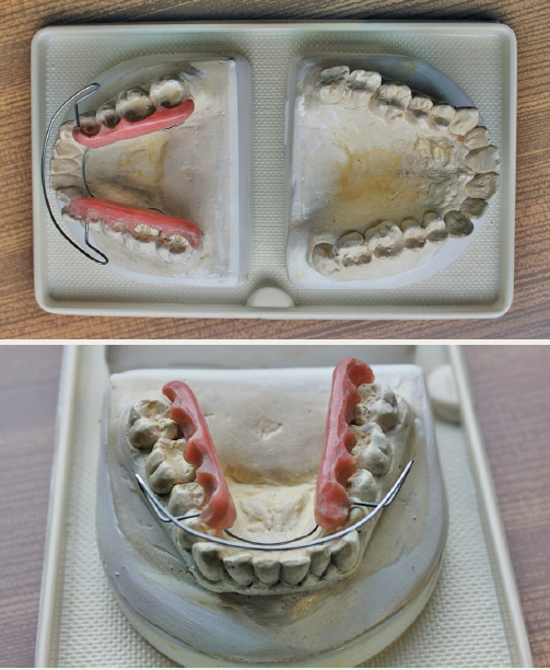 Abb. 1a u. b: Original-Gipsmodelle der Kiefer von Prof. Dr. Hans Peter Bimler mit darauf gefertigtem Gebissformer. Selbstversuch um 1950. Die Vorher- und Nachher-Situation einer frühen Arbeit mithilfe des neuen Gebissformers.