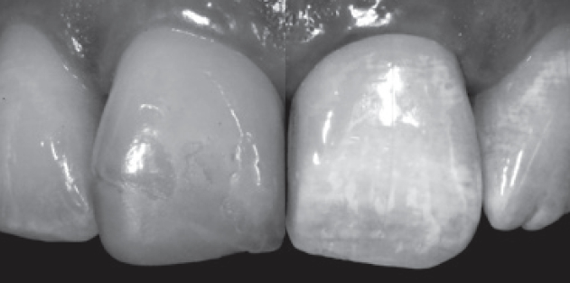 Abb. 1: Im vorliegenden Fall handelt es sich um einen insuffizienten Kantenaufbau an Zahn 11, der inzisal gering frakturiert ist. In Schwarz-Weiß lassen sich die weißlichen Areale und die abweichenden Helligkeitsgrade des bestehenden Füllungsbereichs besser darstellen.