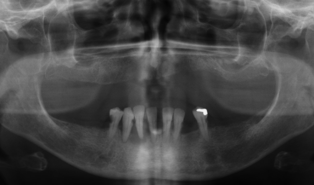 Abb. 1: OPG bei Erstvorstellung der Patientin.