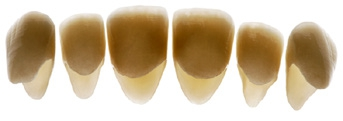 Abb. 1a: Full-wrap(360°)-Veneers für den Oberkieferfrontzahnbereich mit einem Gerüst aus Lithiumdisilikatkeramik (IPS e.max Press, Ivoclar Vivadent) und Verblendung aus einer Nano-Fluorapatit-Glaskeramik (IPS e.max Ceram).