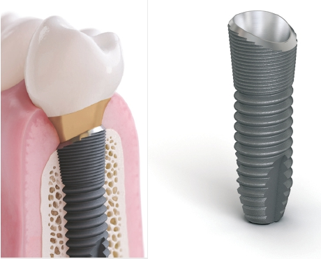 Abb. 1a und b: Grafische Darstellung OsseoSpeed Profile EV. Die abgeschrägte Implantatschulter folgt der anatomischen Ausformung des Alveolarkammes (s. vestibulär).