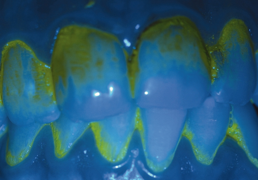 Abb. 1: Die gelb fluoreszierenden Stellen zeigen bakteriellen Biofilm an.