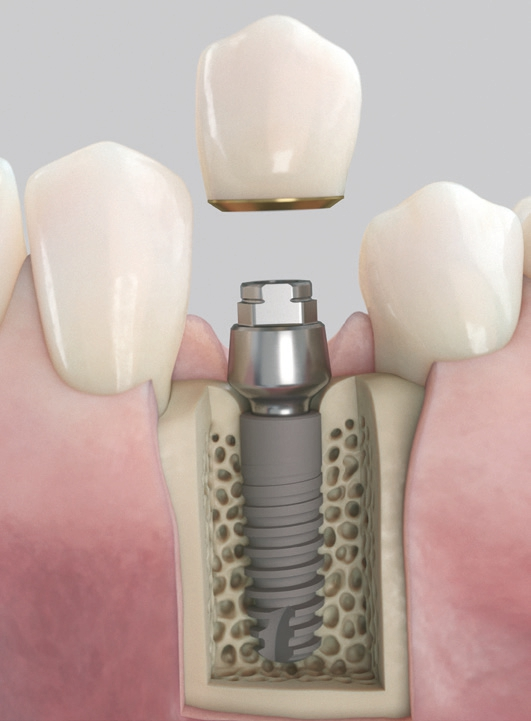 Acuris, das neue konometrische Konzept zur sicheren Befestigung der Krone im abschließenden implantatprothetischen Behandlungsschritt mittels Friktion, anstelle von Schrauben oder Zement.