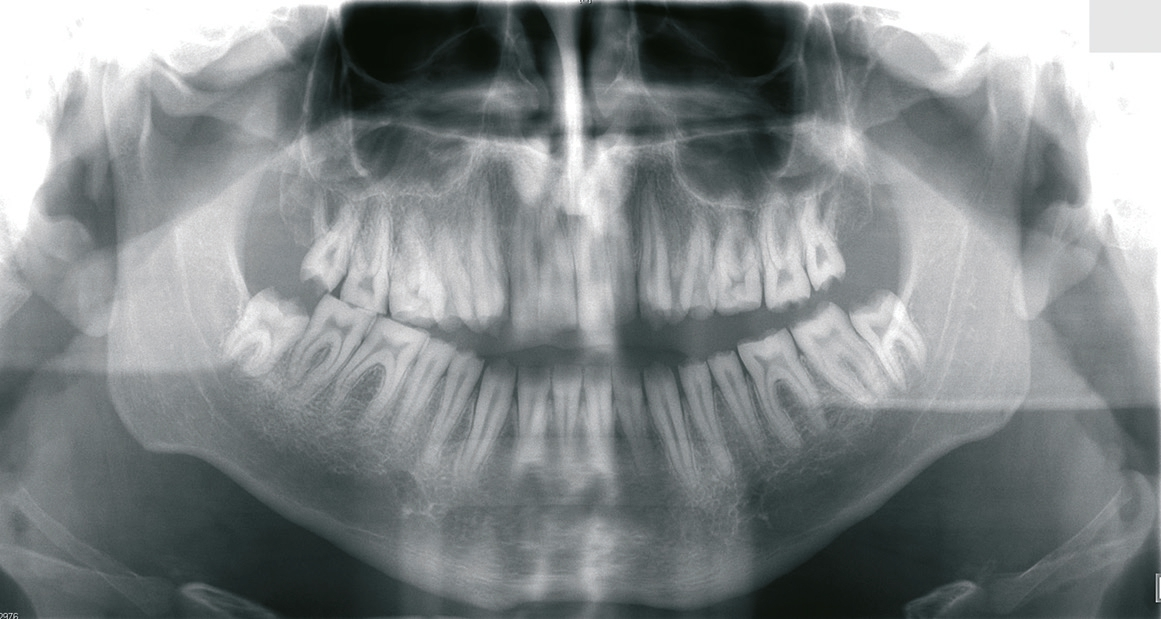 Abb. 1: Im OPG zeigen sich die Zähne mit grazilem Wurzelaufbau ohne Differenzierung zwischen Schmelz und Dentin.