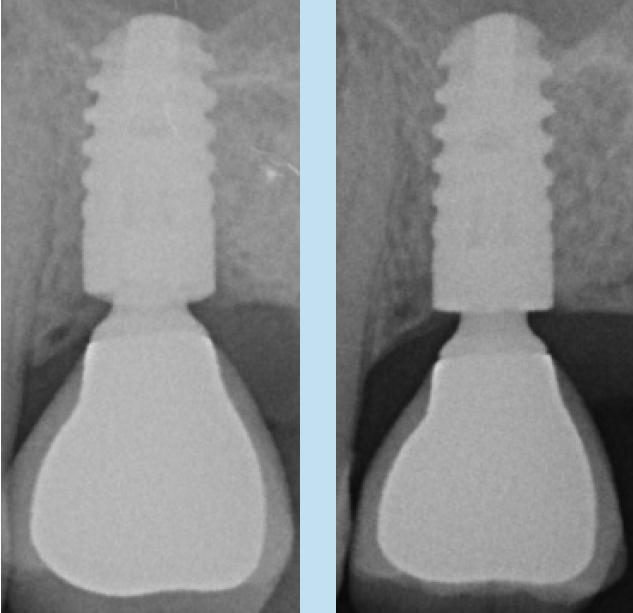 Abb. 1 u. 2: Implantatkrone im Jahr 2010 (unmittelbar nach der Therapie) und Röntgenkontrolle im Jahr 2011.