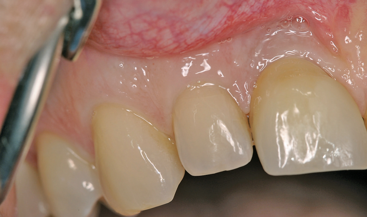 Abb. 1: Ausgangssituation mit interner Resorption an Zahn 12.