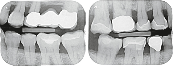 Abb. 1: Bissflügel links und rechts.