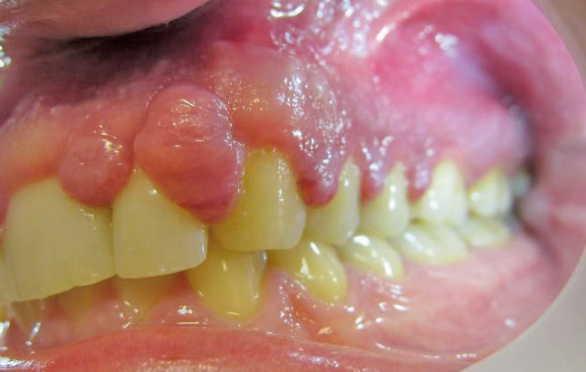 Abb. 1: Präoperativer Befund: Patient mit generalisierter Hyperplasie der Gingiva.