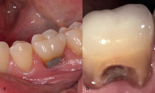 Abb. 1a u. b: Milchzahn 85 (Nichtanlage Position 45): Sekundärkaries und Wurzelresorption, daher nicht erhaltungswürdig.